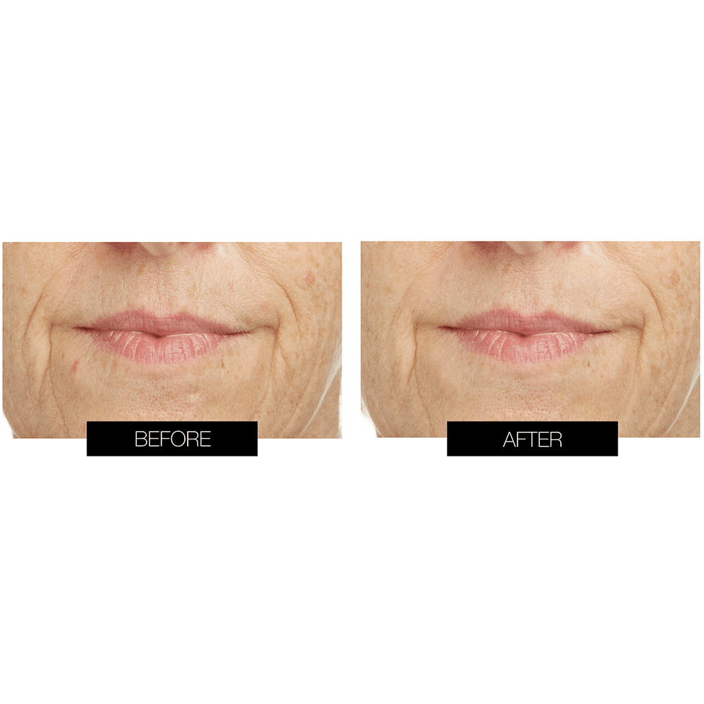 CurrentBody Skin LED Lip & Hydrogel Perfector Kit (10 pack)