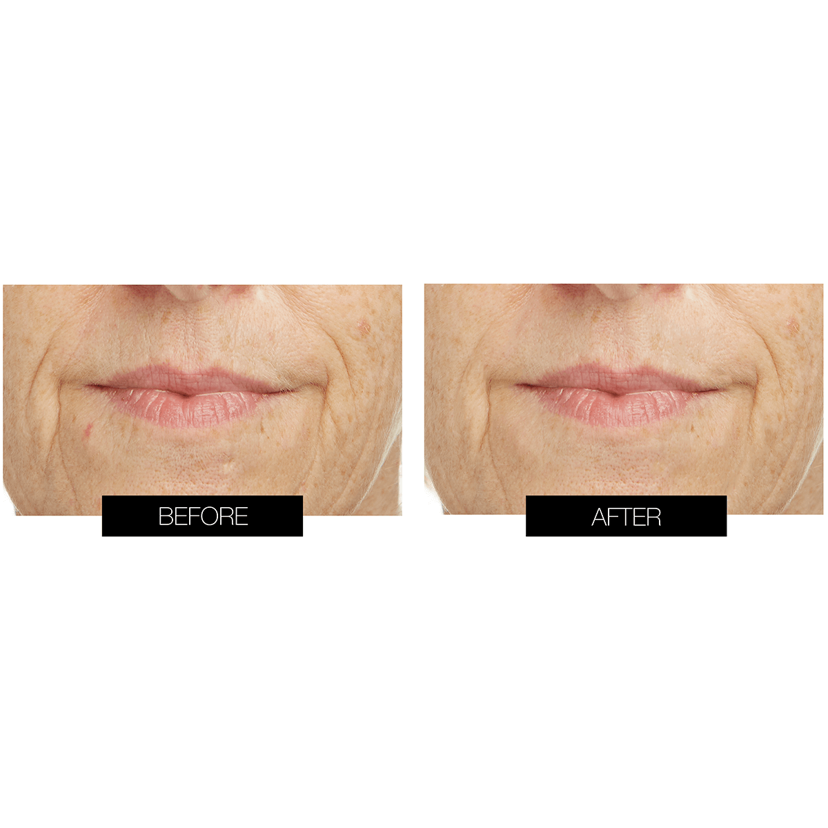 CurrentBody Skin LED Lip & Hydrogel Perfector Kit (10 pack)