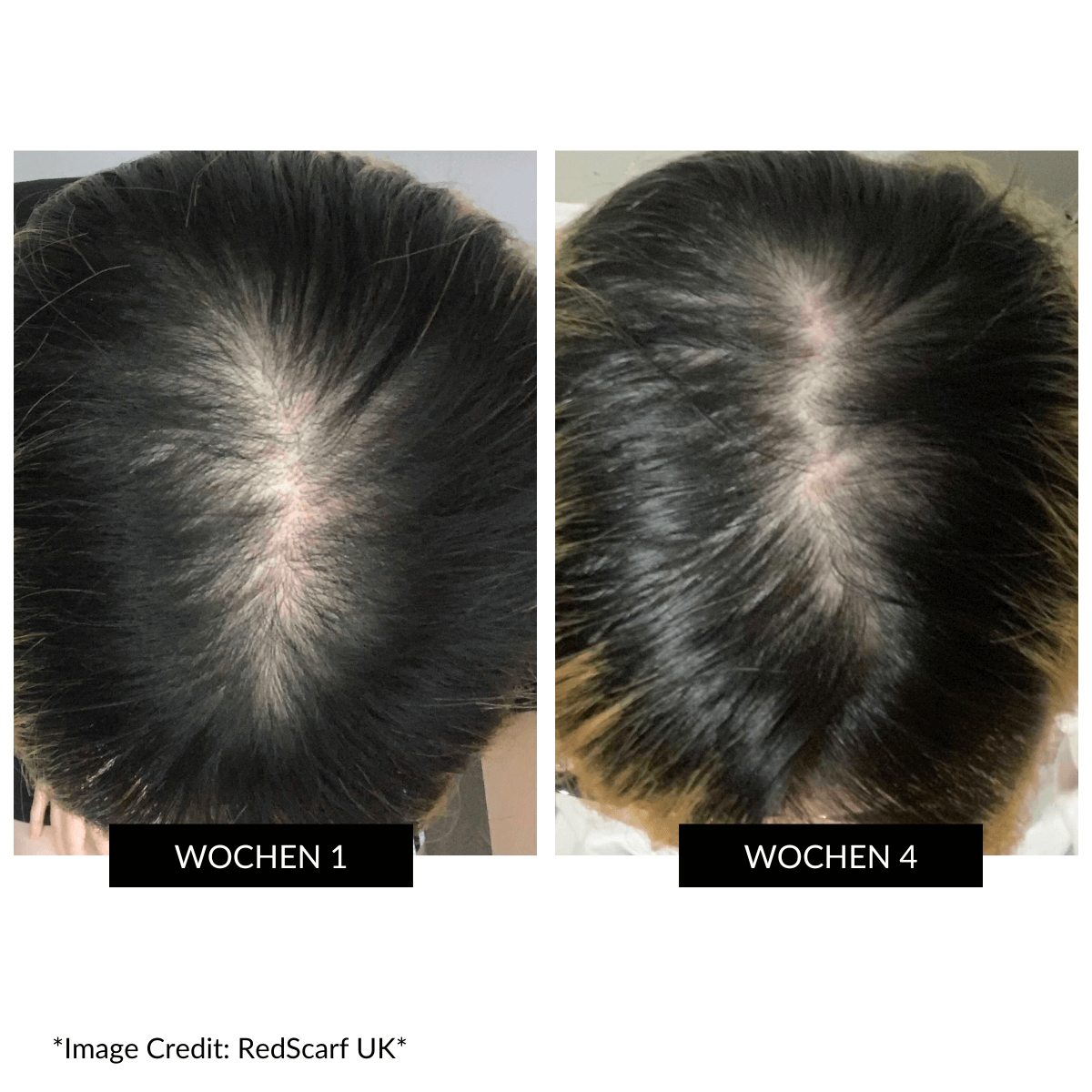 CurrentBody Skin LED Gerät gegen Haarausfall