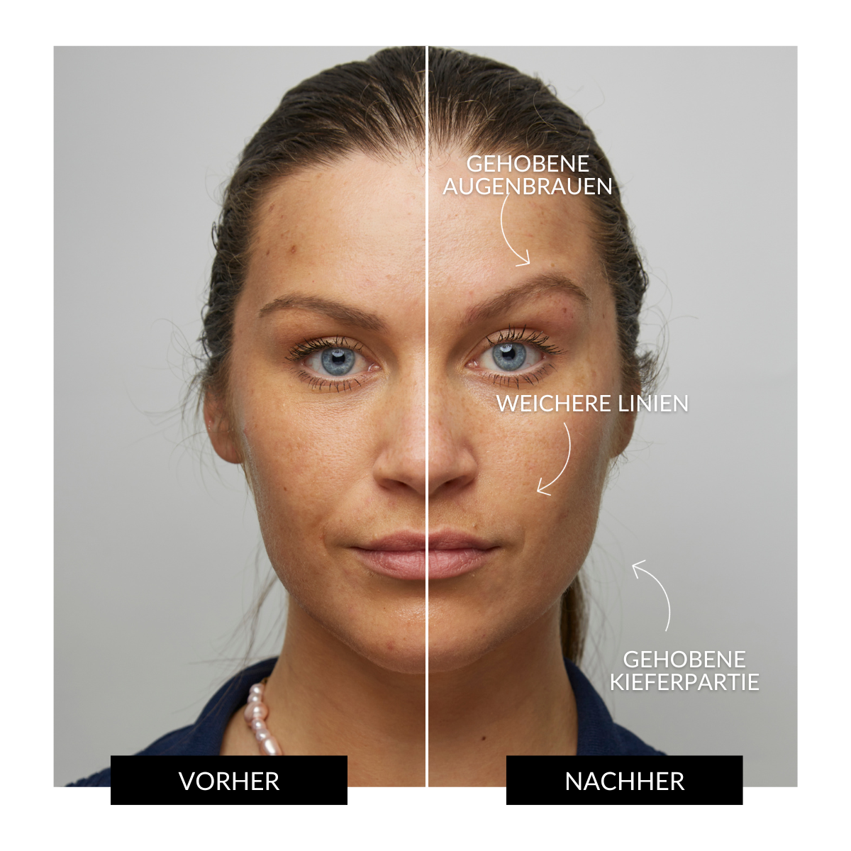 ZIIP HALO Gerät zur Gesichtsstraffung Angebot