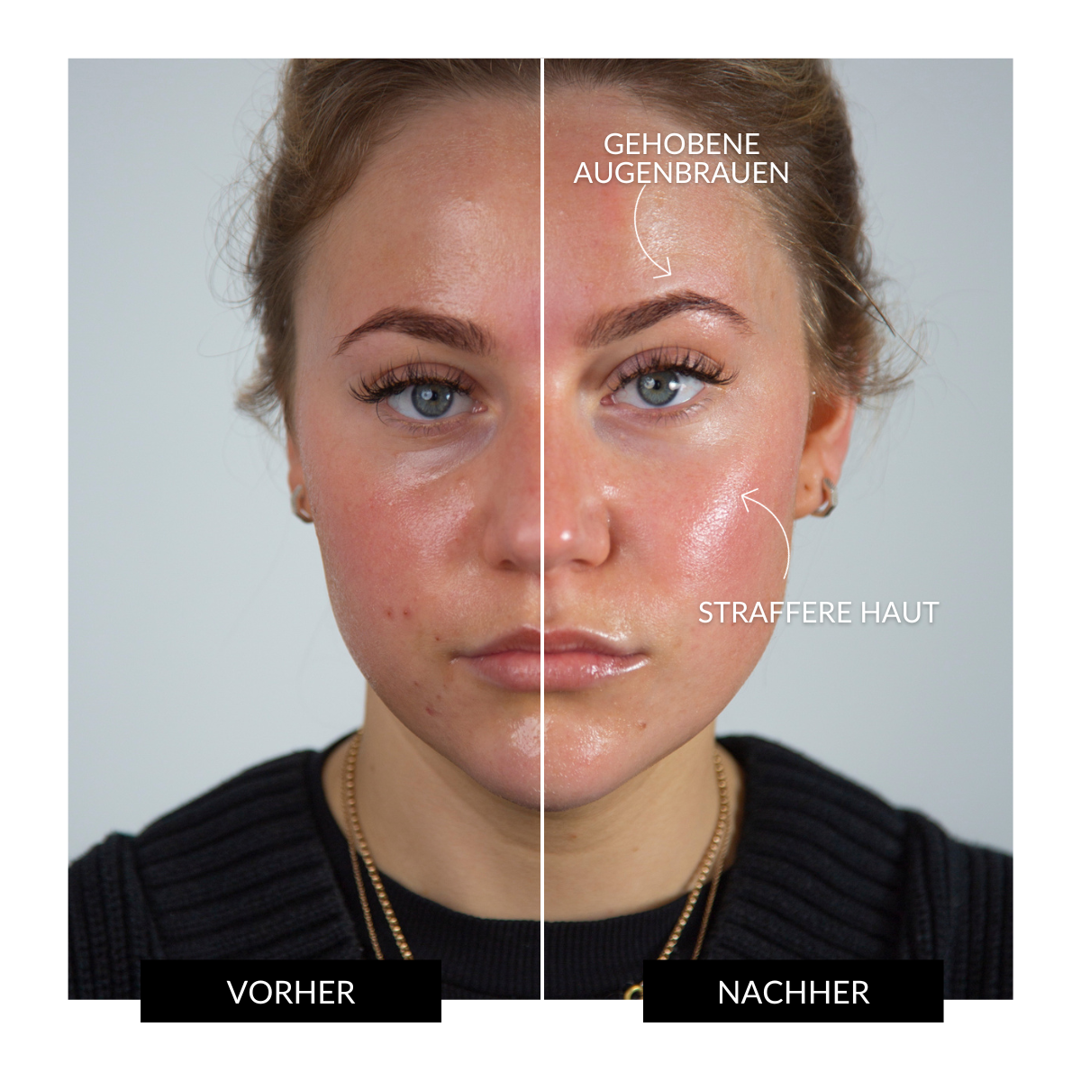 ZIIP HALO Gerät zur Gesichtsstraffung Angebot