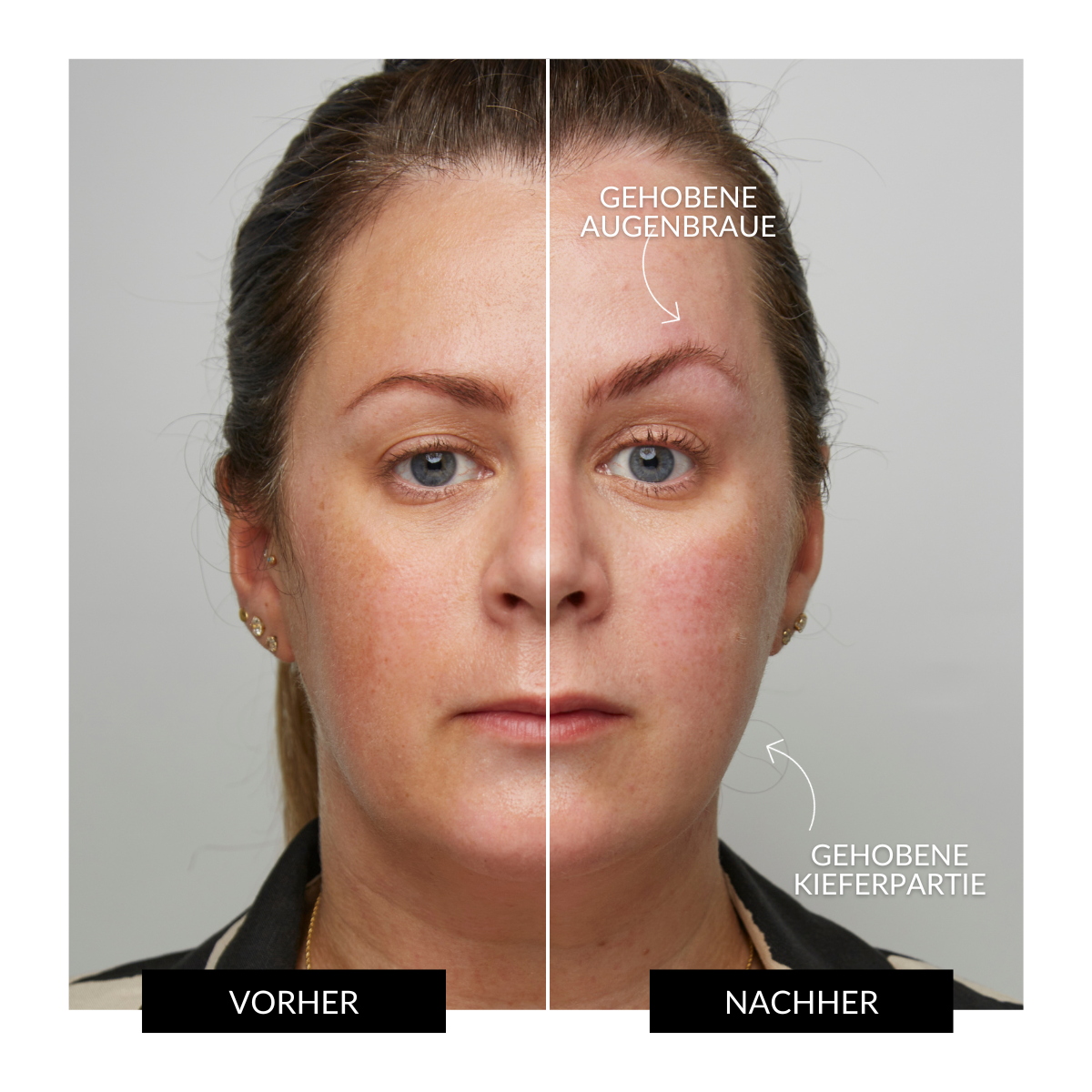 ZIIP HALO Gerät zur Gesichtsstraffung Angebot