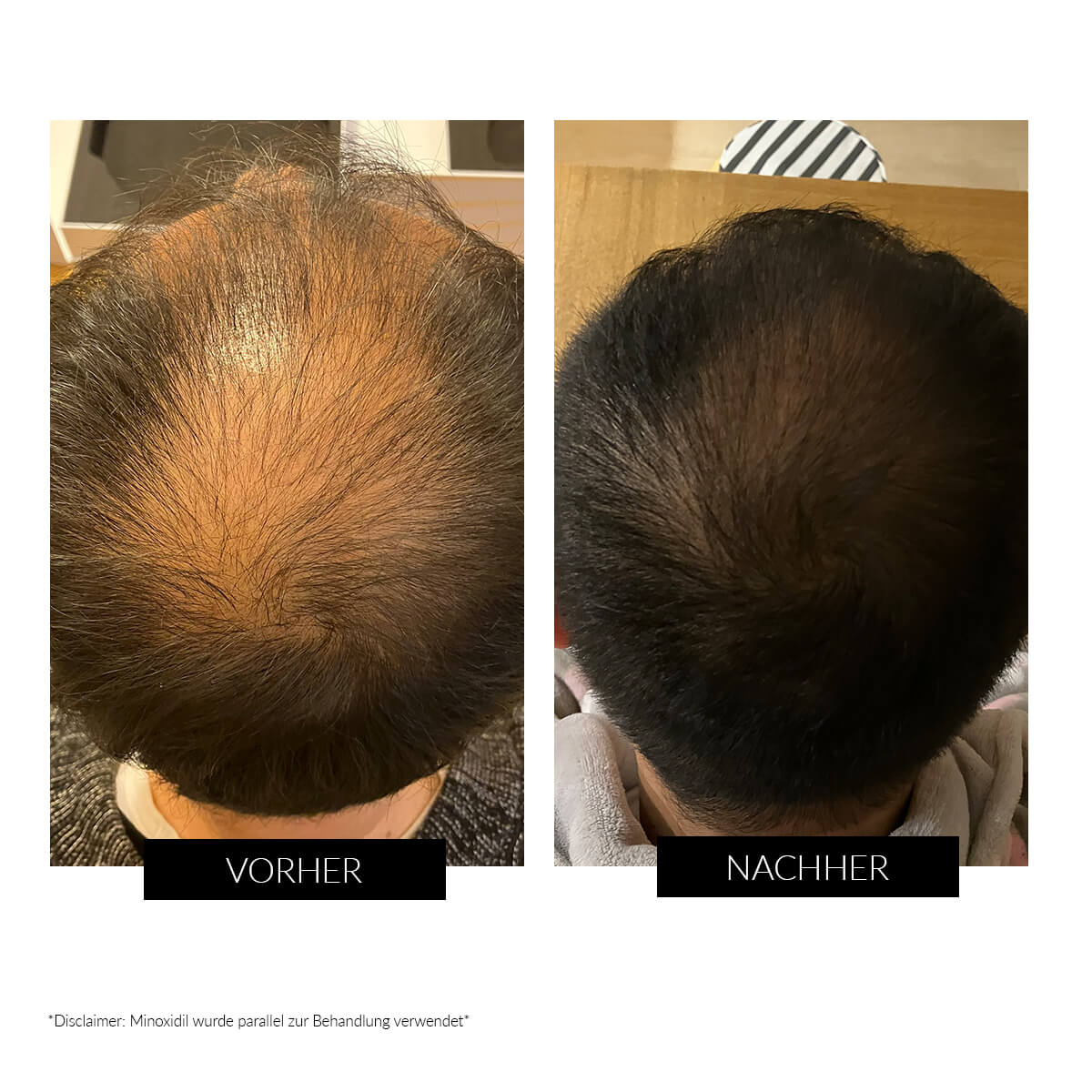 CurrentBody Skin LED Gerät gegen Haarausfall