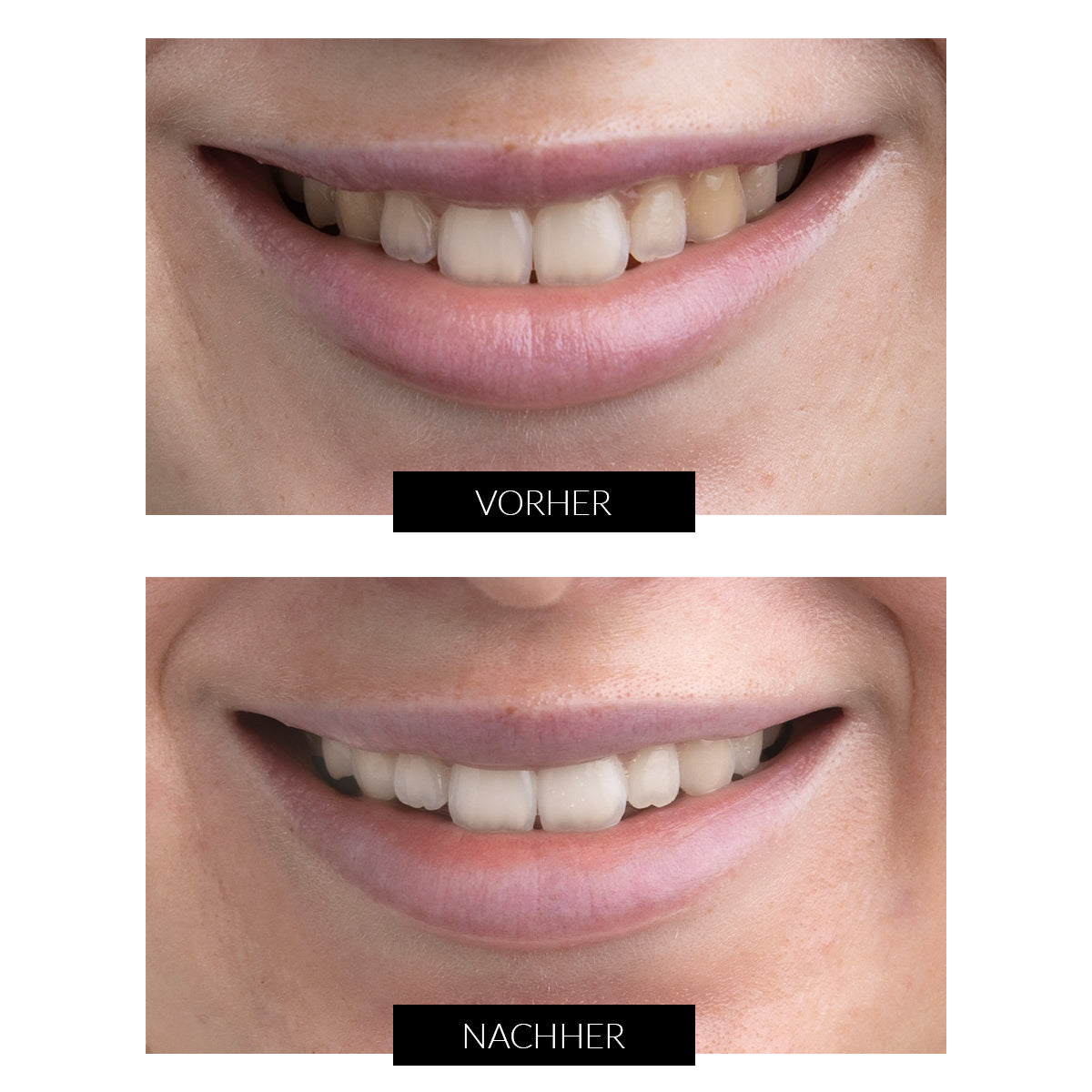 CurrentBody Skin Teeth Whitening Kit Angebot